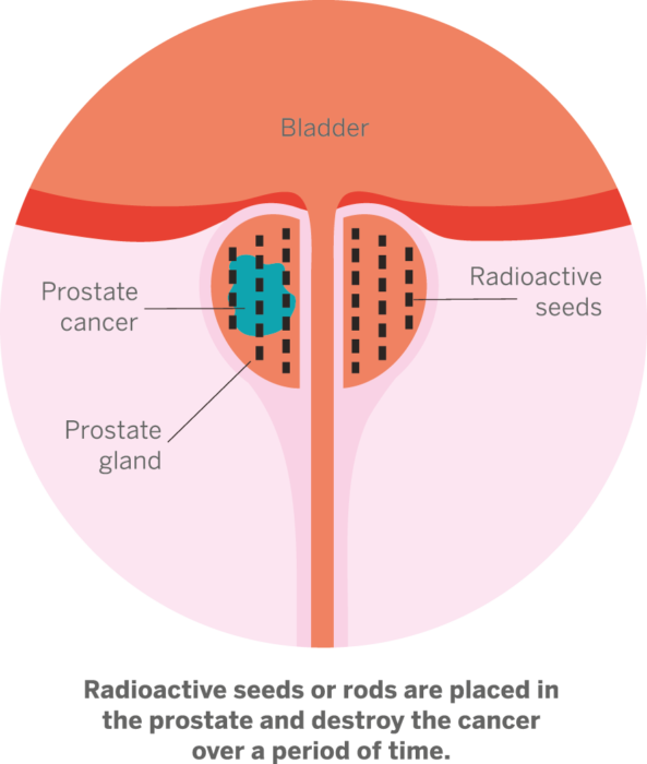 Radical Radiotherapy Prostate Cancer Research