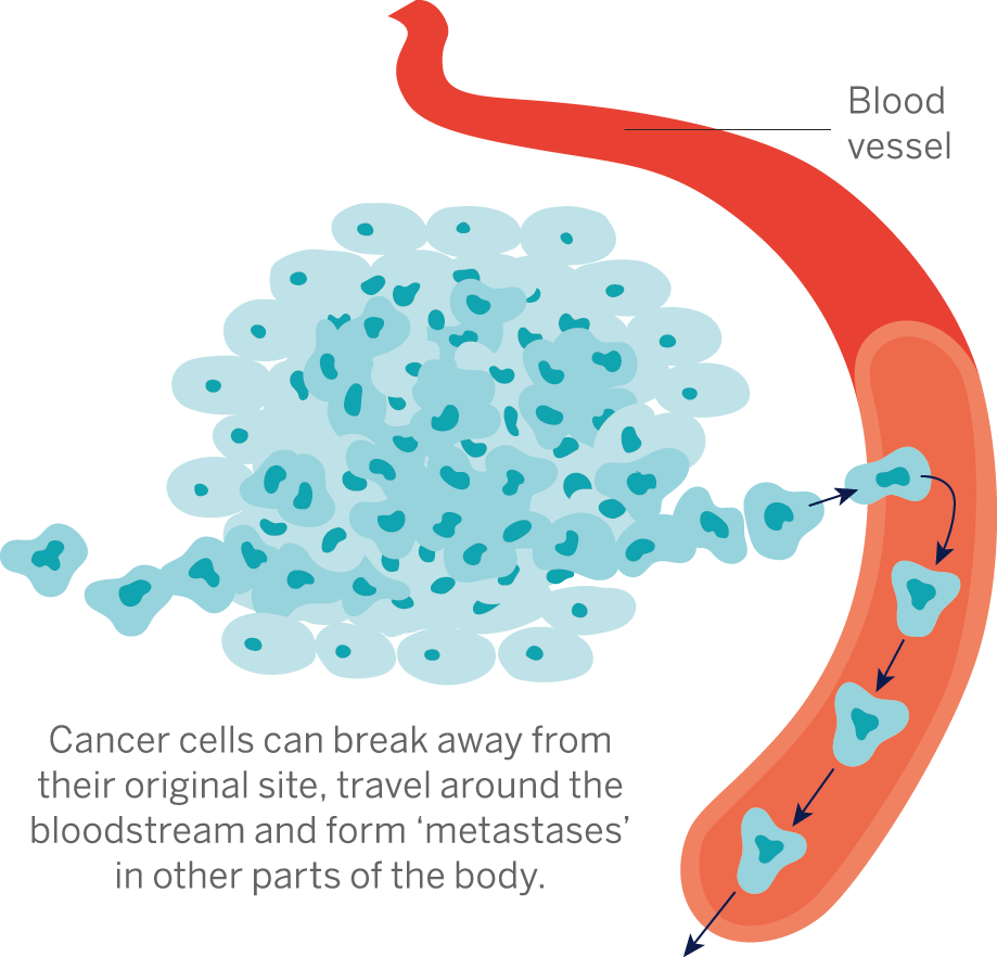 the-spread-of-prostate-cancer-prostate-cancer-research