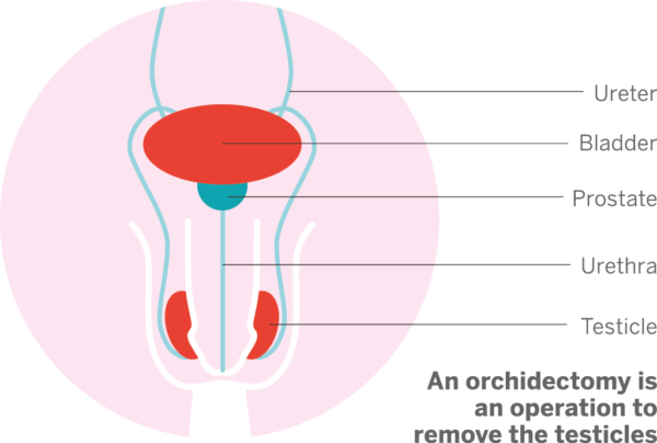 Orchidectomy Prostate Cancer Research