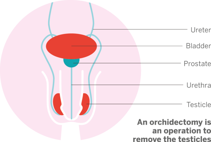 Orchidectomy Prostate Cancer Research